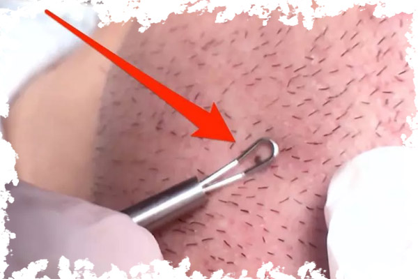 6. موهای زیر پوستی صورتتان را نابود کنید